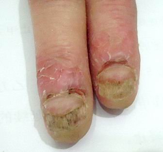 灰指甲患者的表现症状有哪些